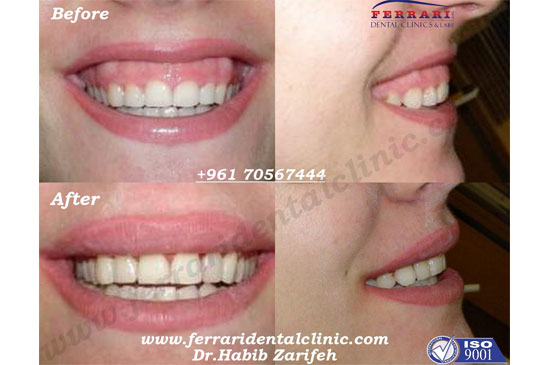 Gummy Smile correction for simple cases