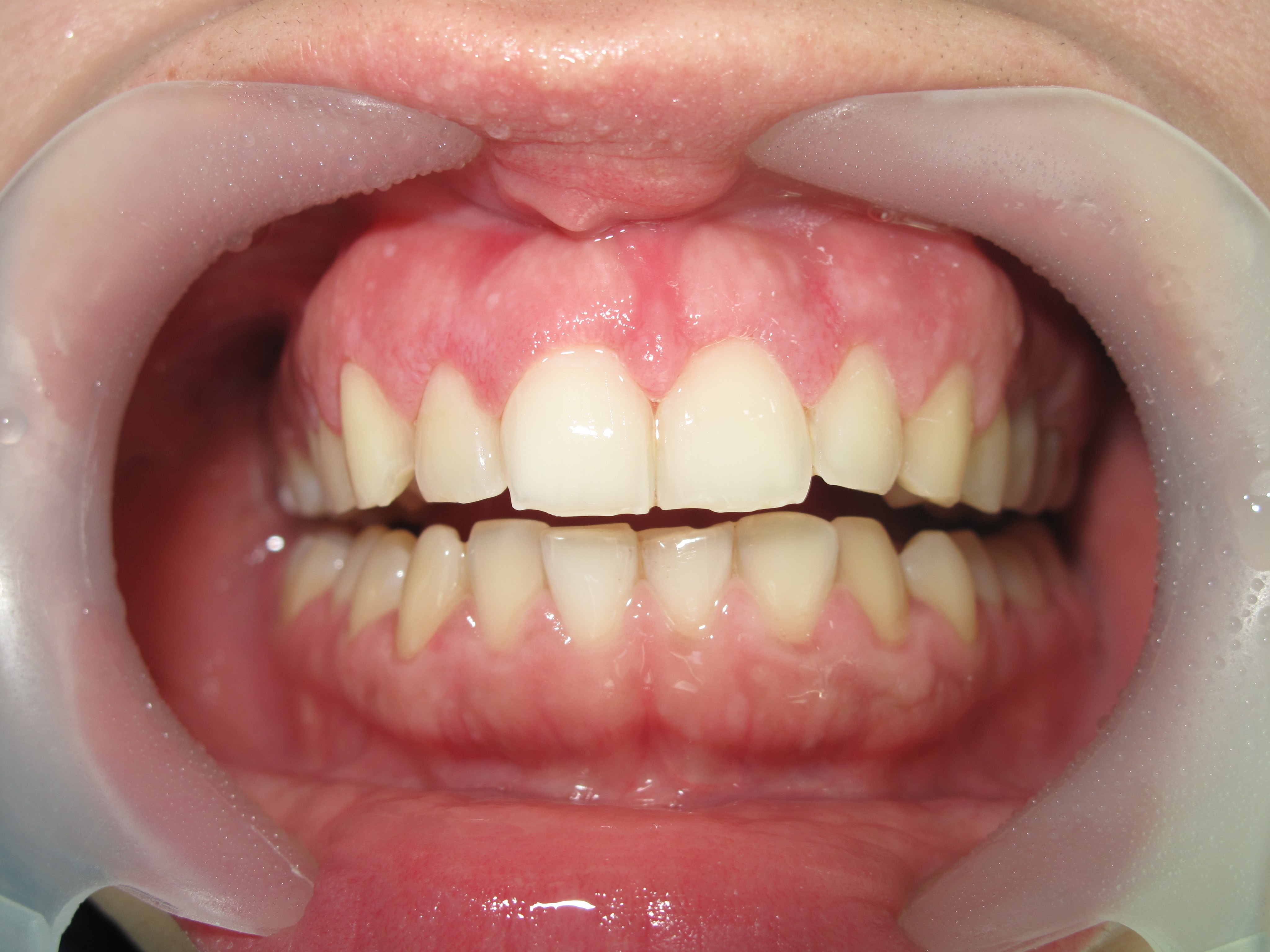 Gummy Smile After Laser Treatment Beirut Lebanon
