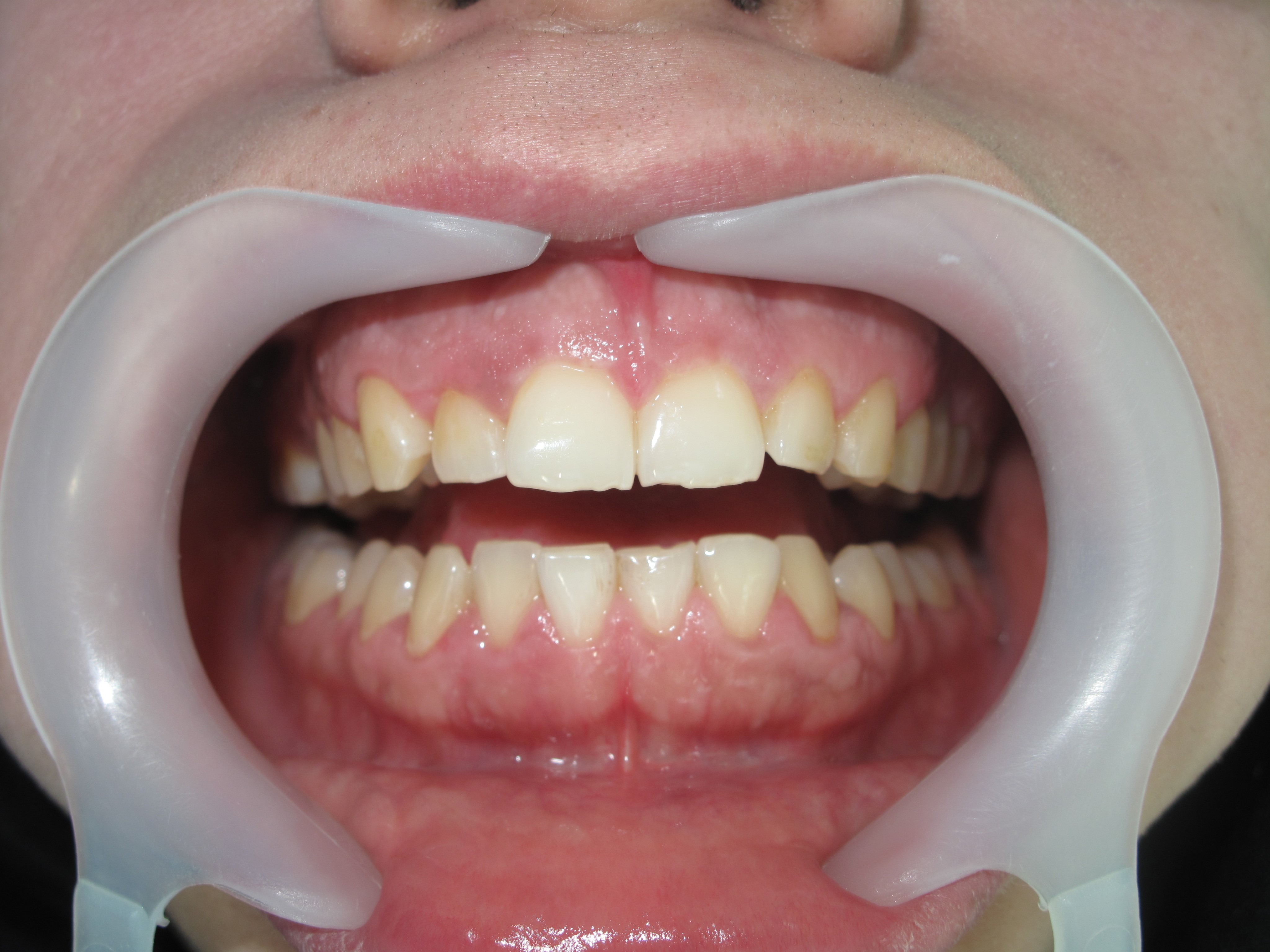 Gummy Smile Before Treatment Beirut Lebanon