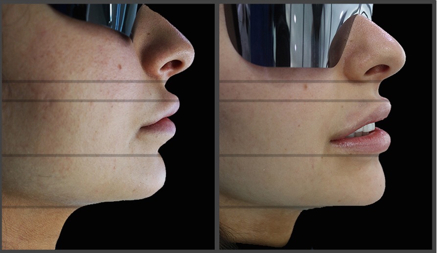 Waterlase Fotona Laser Dentistry Beirut